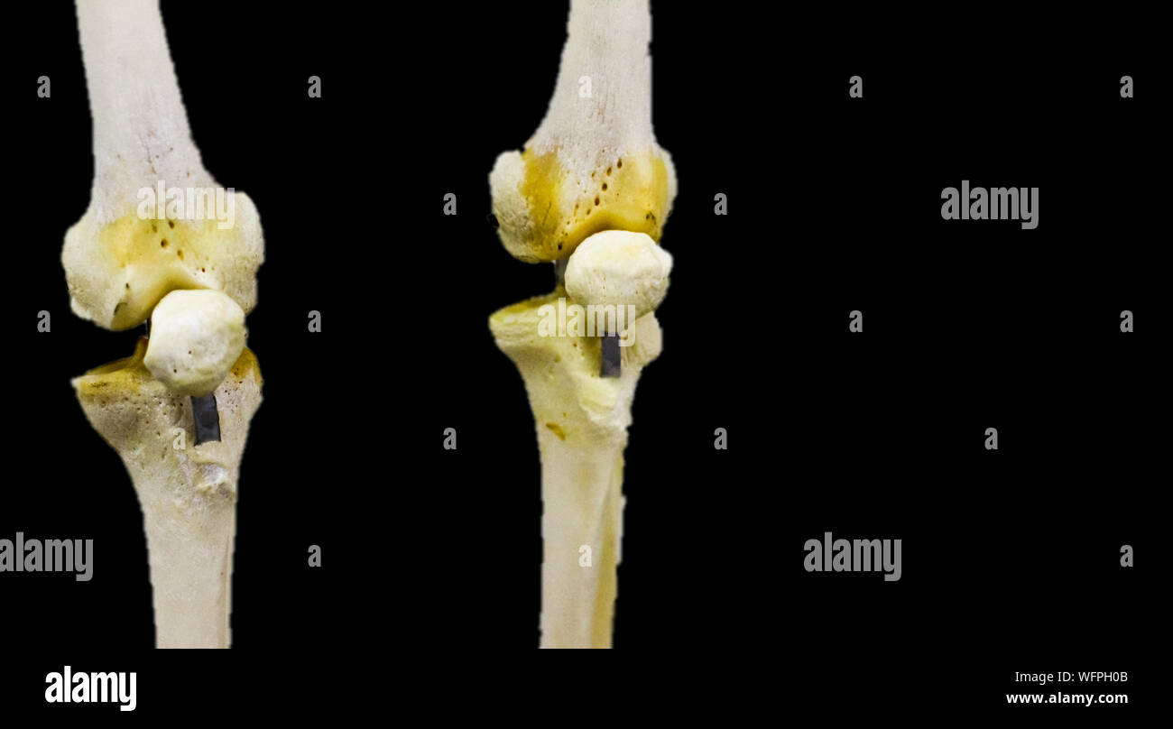 Huesos Rodilla Tibia Perone Y Pie Fotografías E Imágenes De Alta