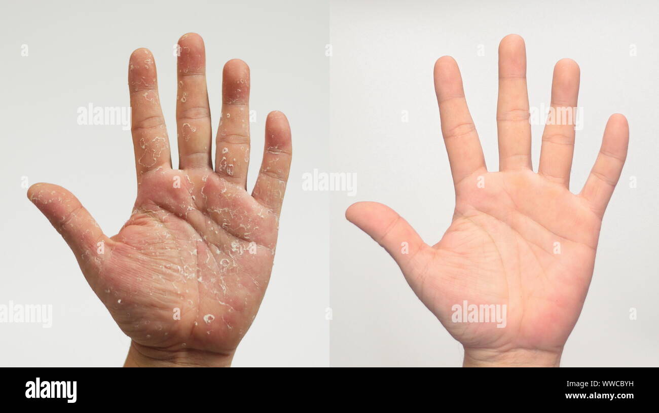 Descamación de la piel de la palma del pie fotografías e imágenes de alta  resolución - Alamy