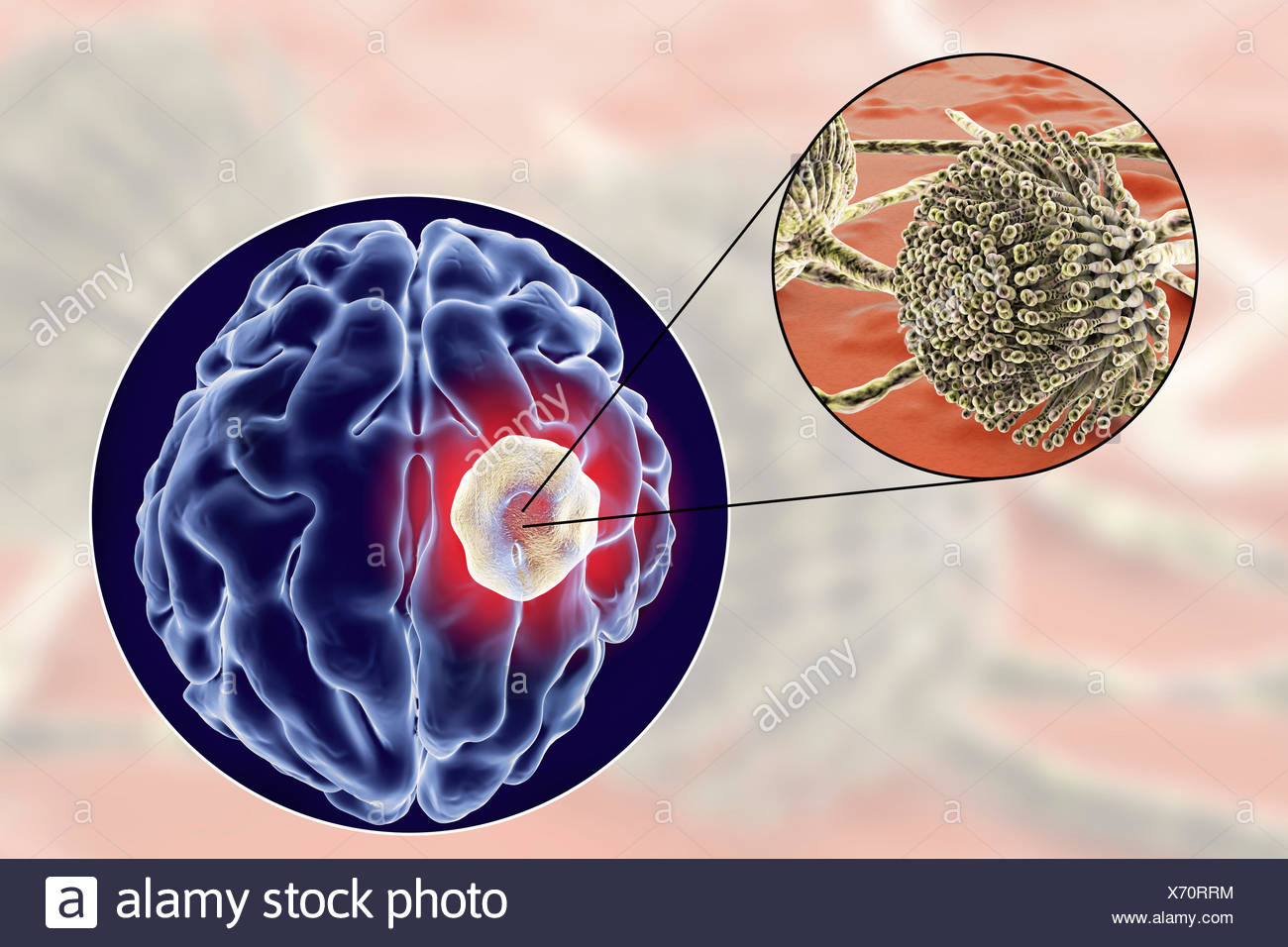 Aspergiloma del cerebro y la vista cercana de hongos del género Aspergillus, equipo de ilustración. También conocido como micetoma, o bola de hongos, esta es una lesión intracraneal, producidas por los hongos Aspergillus en pacientes inmunocomprometidos. Foto de stock