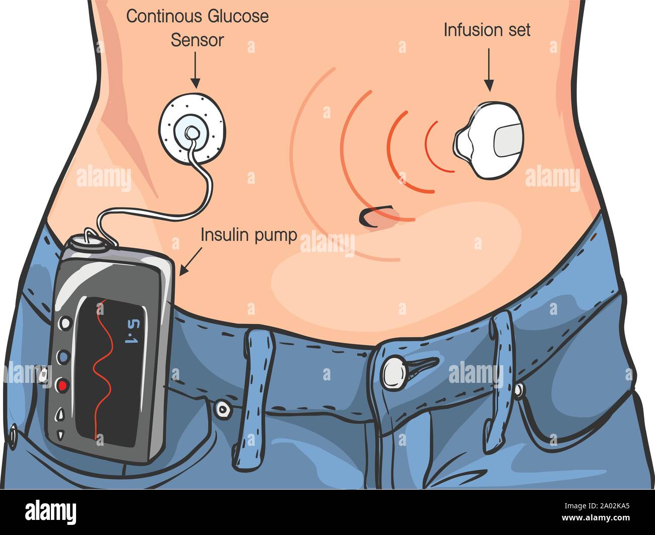 Les pompes à insuline pour le Diabète Les patients Vector İllustration Illustration de Vecteur