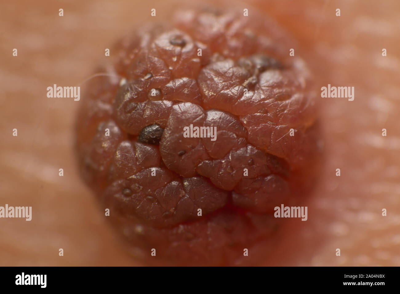 Mole sur la peau du corps. Tâche de naissance. Acrochordon. Banque D'Images