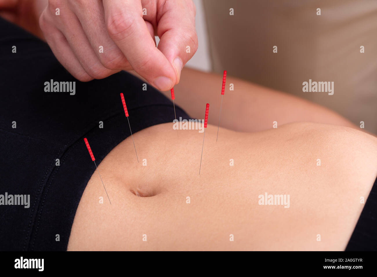 Close-up of main du médecin effectuer un traitement d'acupuncture médicale professionnelle dans un institut de beauté sur le corps de la femme Banque D'Images