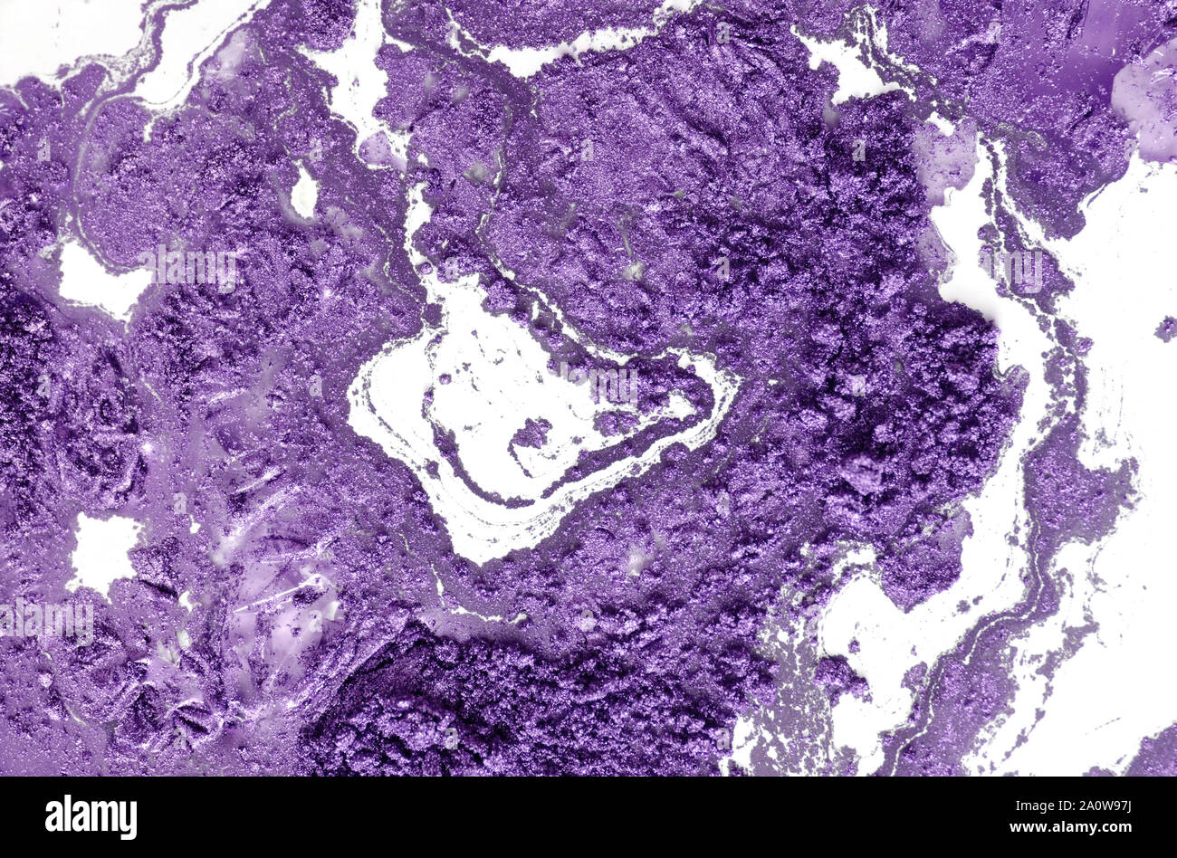 L'adénocarcinome peu différencié de la lumière intestinale, micrographie, photo sous microscope Banque D'Images
