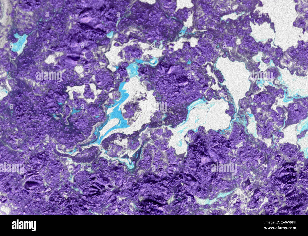L'adénocarcinome peu différencié de la lumière intestinale, micrographie, photo sous microscope Banque D'Images