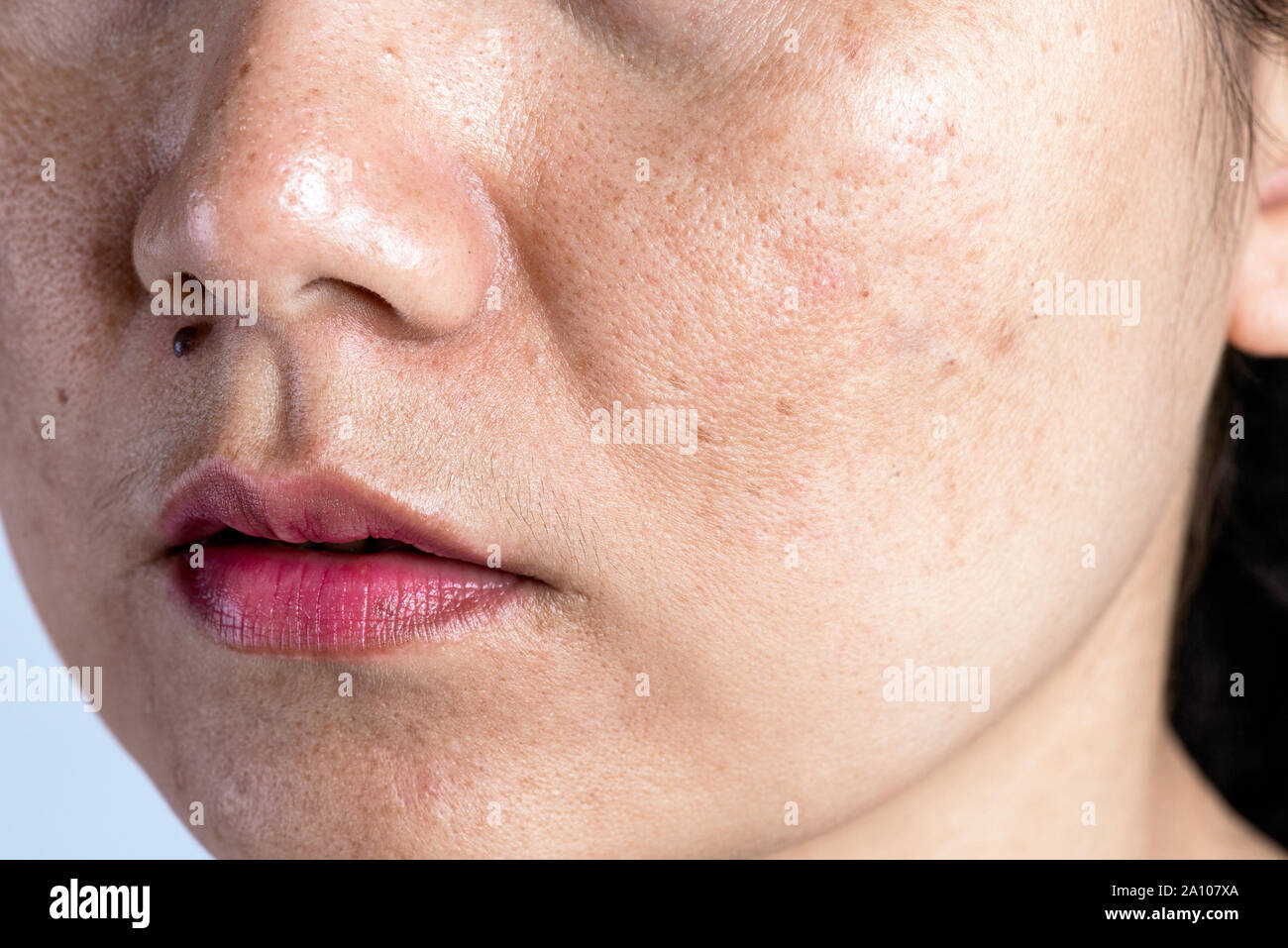 Femme avec un problème de la peau et des cicatrices d'acné. Problème de  santé et soins de la concept. Les taches de rousseur melasma rides peau  sèche et de pigmentation sur fac