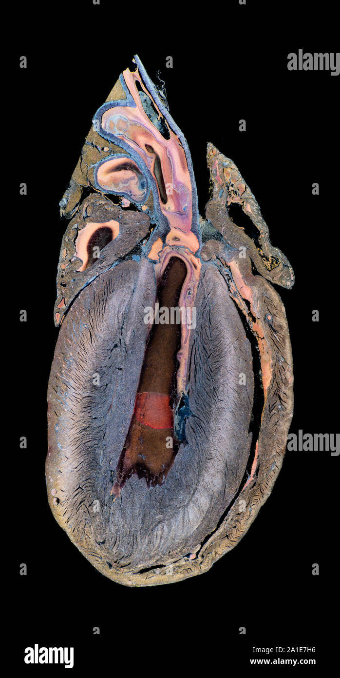 La section pied fœtal humain montrant structure générale, darkfield photomicrographie Banque D'Images