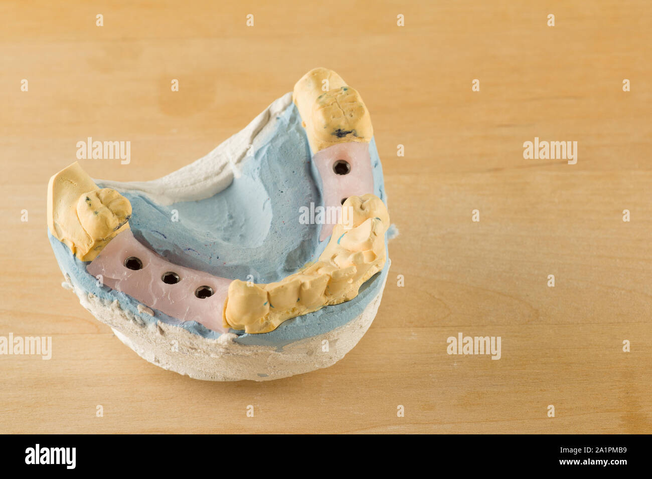 Modèle en plâtre de la mâchoire avec les analogues de l'implant dentaire Banque D'Images