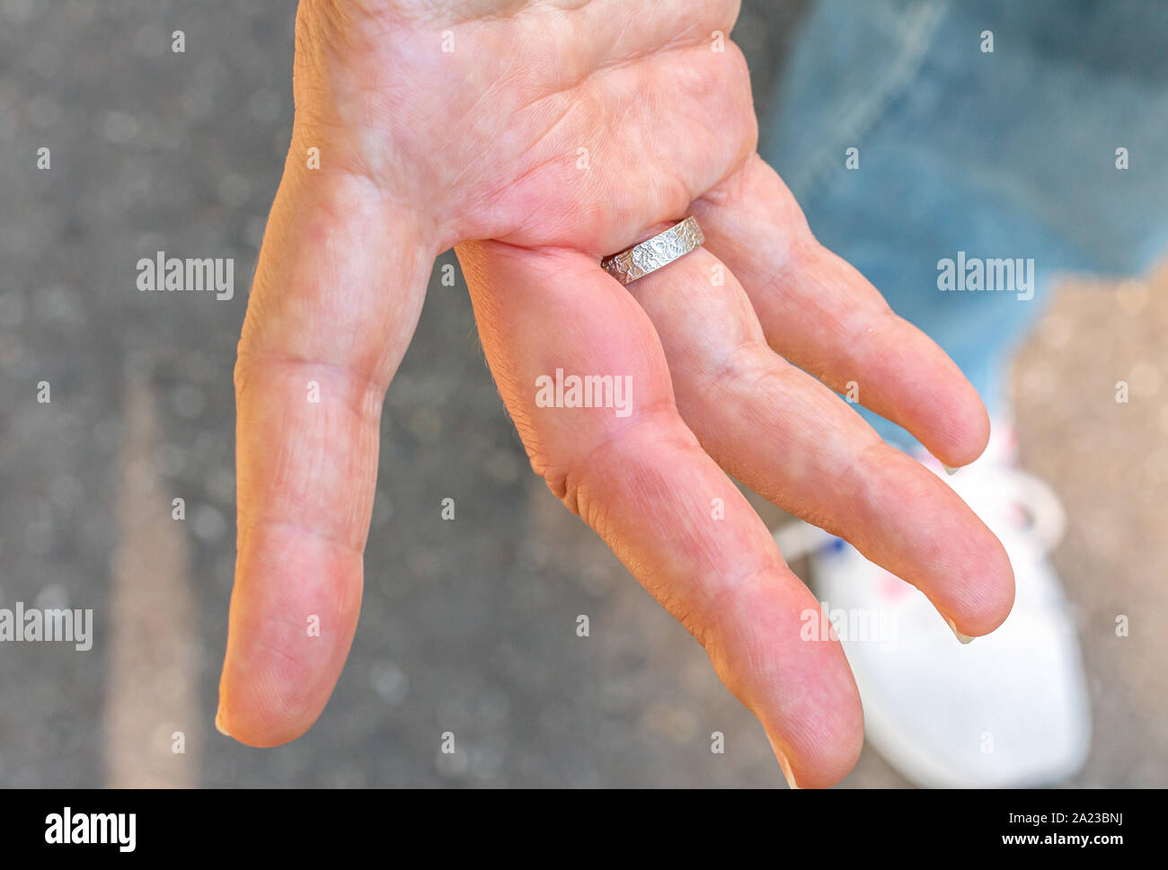 Une main droite avec un doigt enflé après une piqûre d'abeille Banque D'Images
