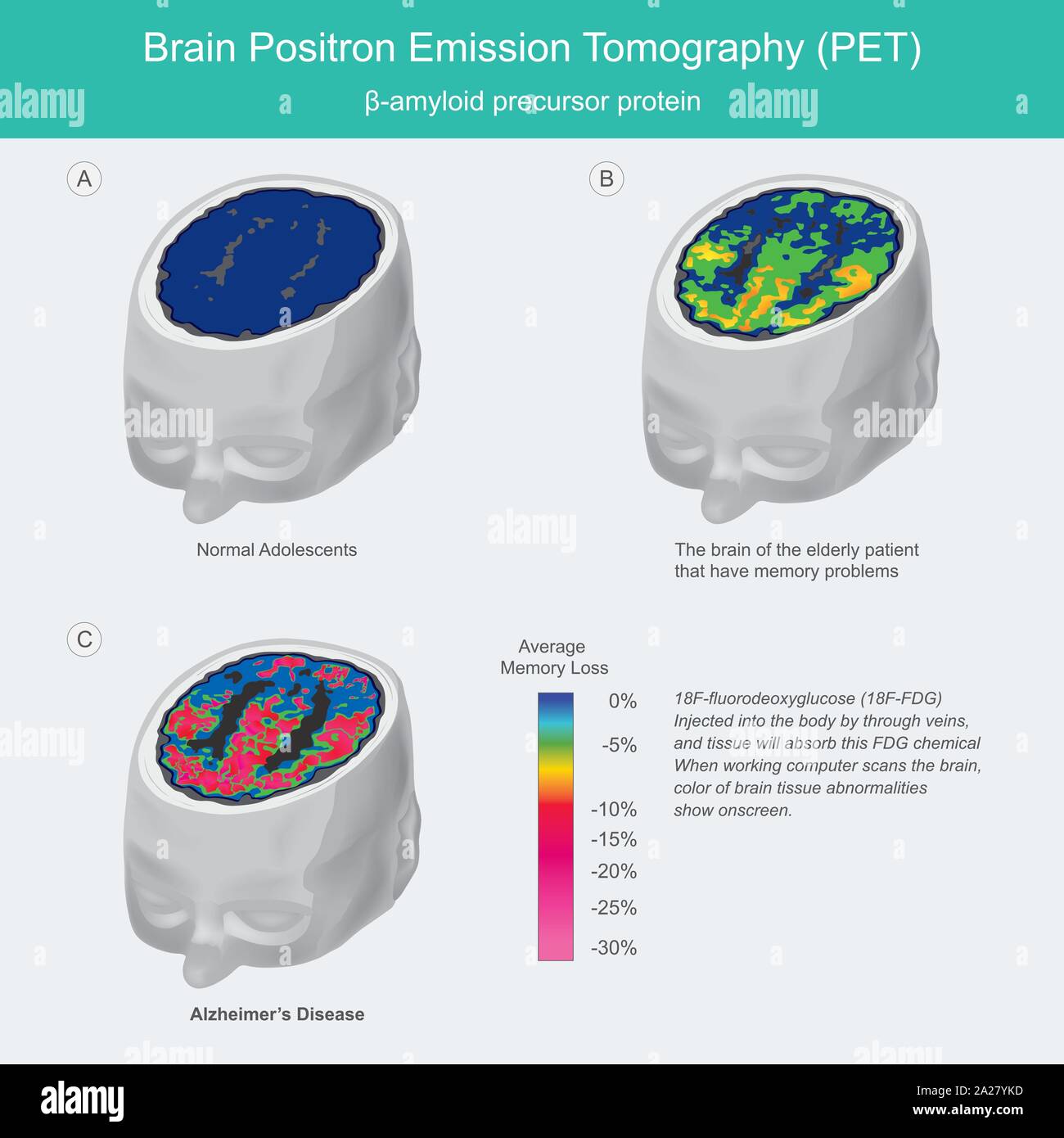 La TEP du cerveau. En cas de travail ordinateur analyse le cerveau, la couleur des tissus du cerveau montrent des anomalies à l'écran. Illustration de Vecteur