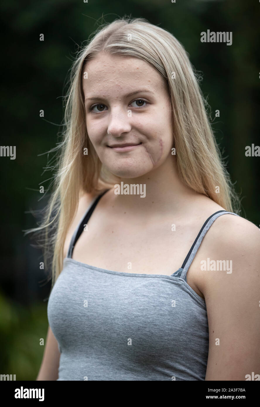 Emily Eccles, à son domicile dans le Yorkshire, après qu'elle a subi une des pires blessures au visage les médecins ont vu, à l'extérieur d'une zone de guerre, dans un accident d'équitation. Banque D'Images