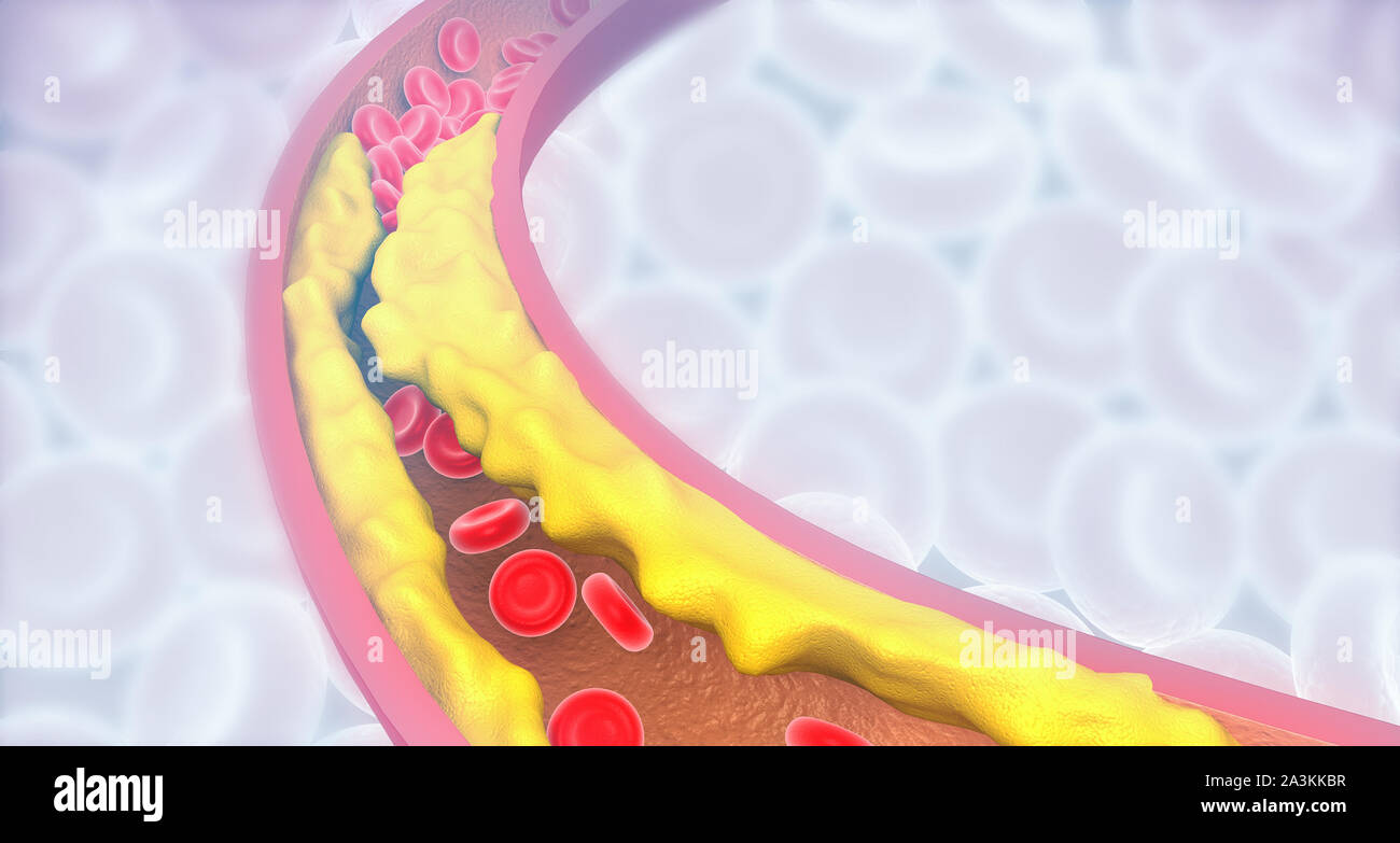 Blocage de l'artère avec mauvais cholestérol. artères obstruées, plaque de l'artère coronaire. 3d illustration Banque D'Images