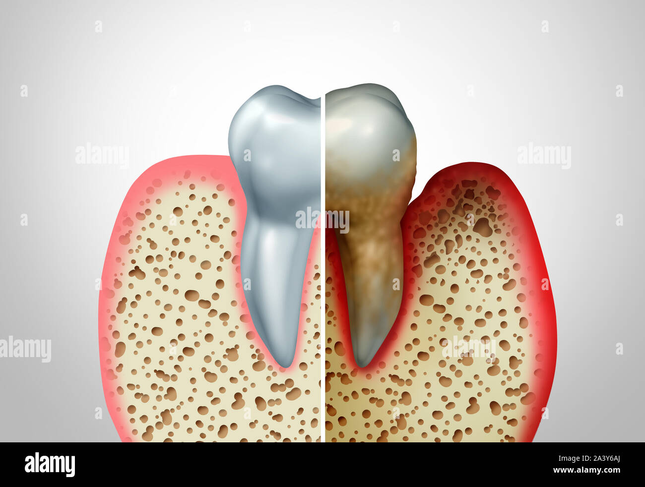 Les maladies de gencive comparaison avec une dent saine et un climat malsain avec une parodontite et une mauvaise hygiène buccale comme un problème de santé l'infection par des bactéries. Banque D'Images
