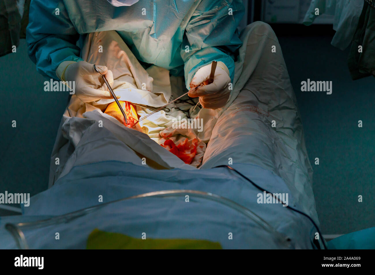 Salle d'opération de l'équipe de chirurgiens travaillant sur des patients de jambe Banque D'Images