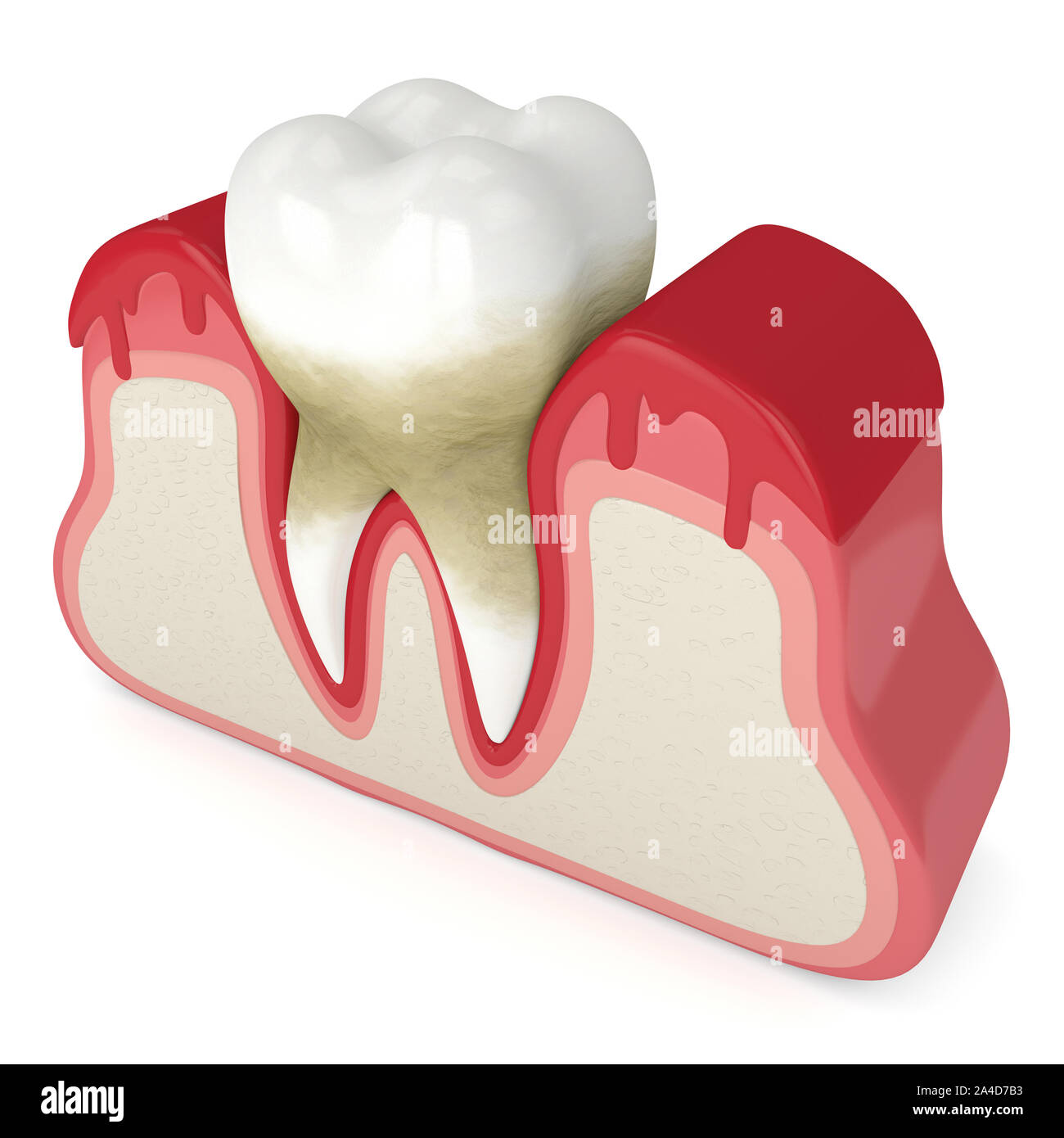 3D render of dent dans le saignement des gencives sur fond blanc. La maladie parodontale concept. Banque D'Images