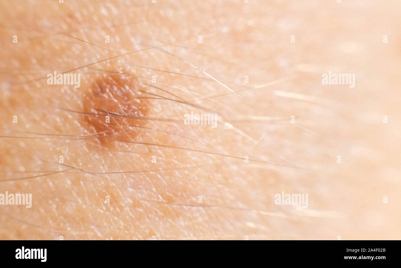 Petit mole nevus sur la peau humaine, du carcinome. Arrièreplan — free download