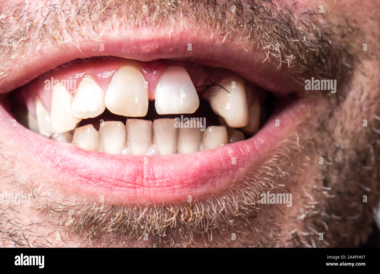 L'écart des dents après une chirurgie d'un kyste Banque D'Images