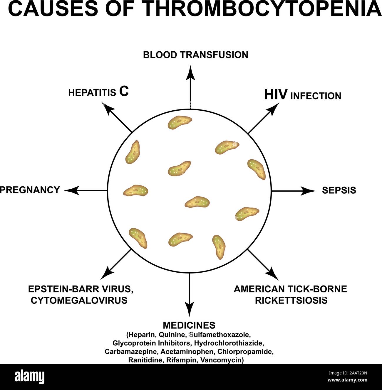 Causes de la thrombocytopénie. La réduction des plaquettes dans le sang. L'infographie. Vector illustration sur fond isolé. Illustration de Vecteur
