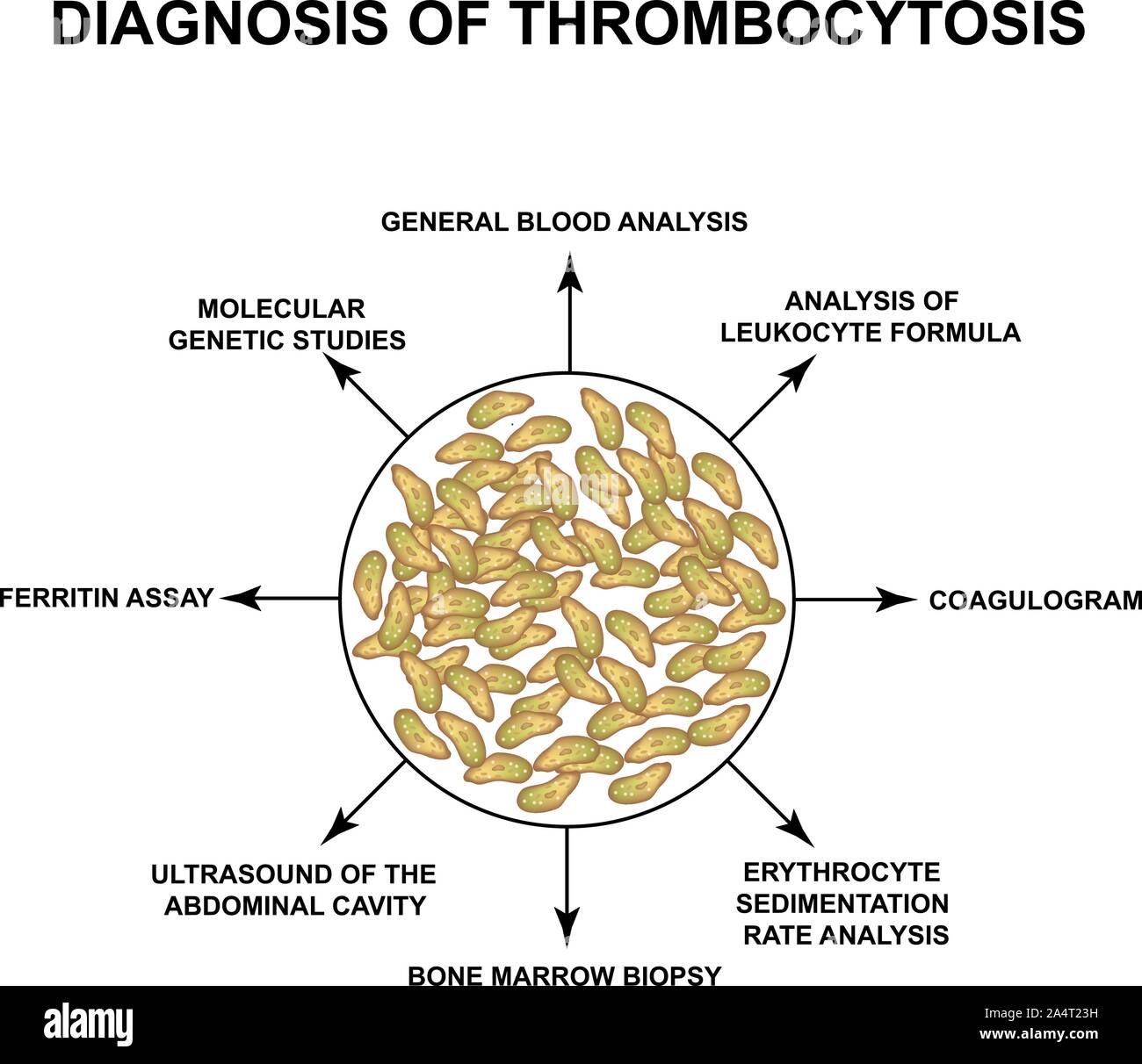 Diagnostic d'une thrombocytose. Une augmentation des plaquettes dans le sang. L'infographie. Vector illustration sur fond isolé. Illustration de Vecteur
