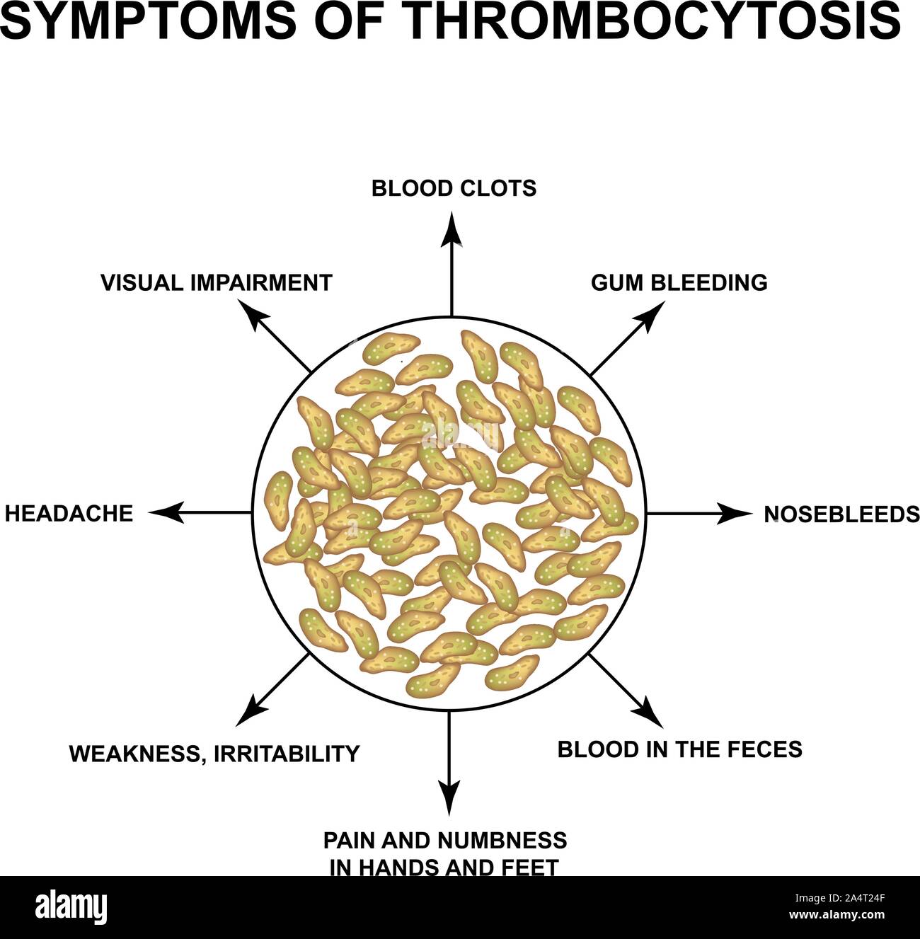 Les symptômes d'une thrombocytose. Une augmentation des plaquettes dans le sang. L'infographie. Vector illustration sur fond isolé. Illustration de Vecteur