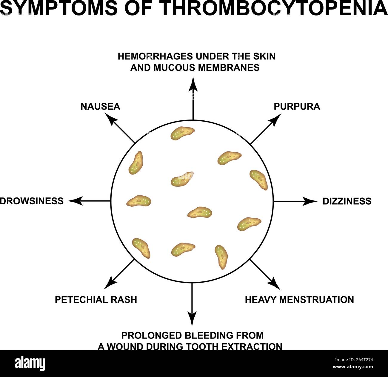 Les symptômes d'une thrombocytopénie. La réduction des plaquettes dans le sang. L'infographie. Vector illustration sur fond isolé. Illustration de Vecteur
