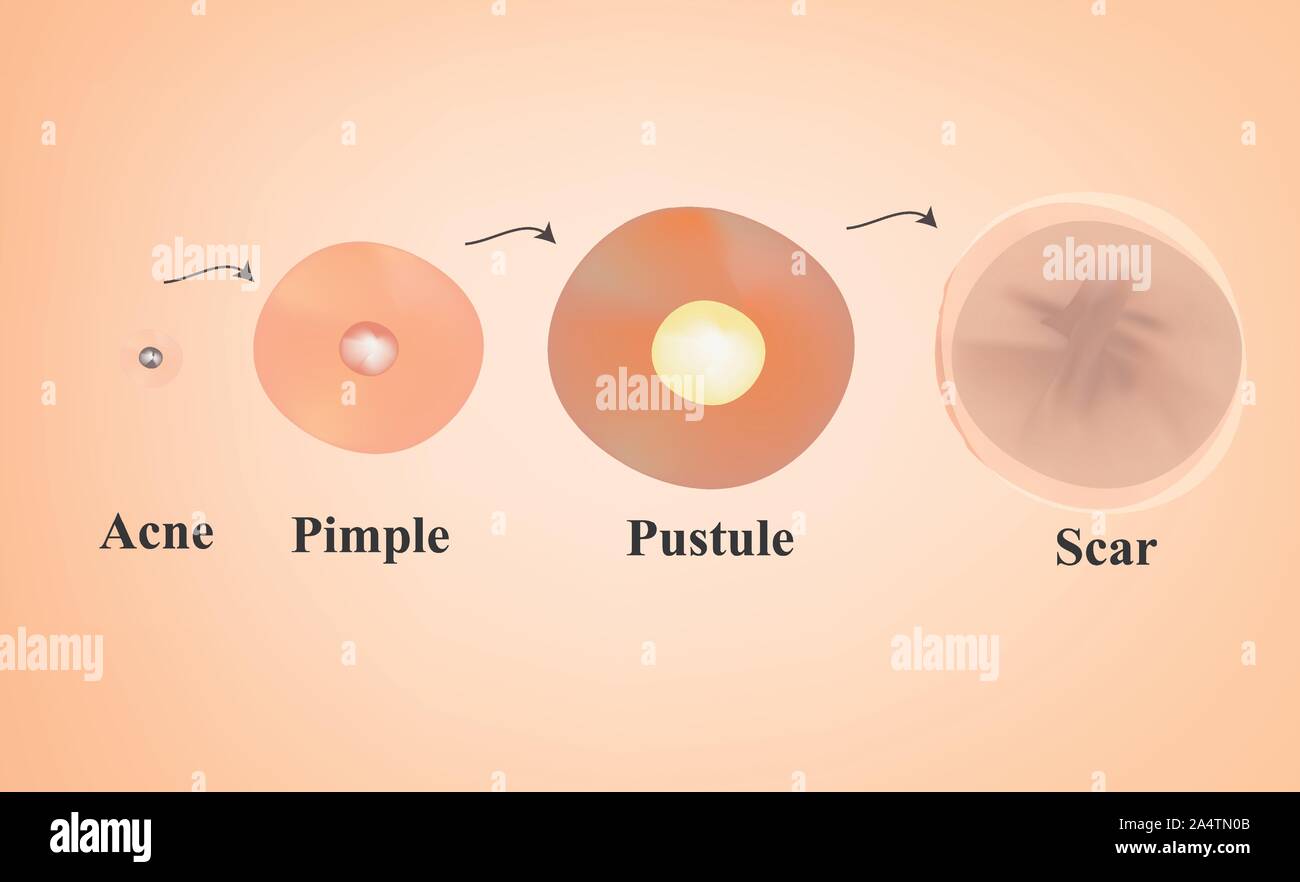 Types de points noirs, acné, pustules. La peau après l'acné cicatrices et l'acné. L'infographie. Vector illustration sur fond isolé. Illustration de Vecteur