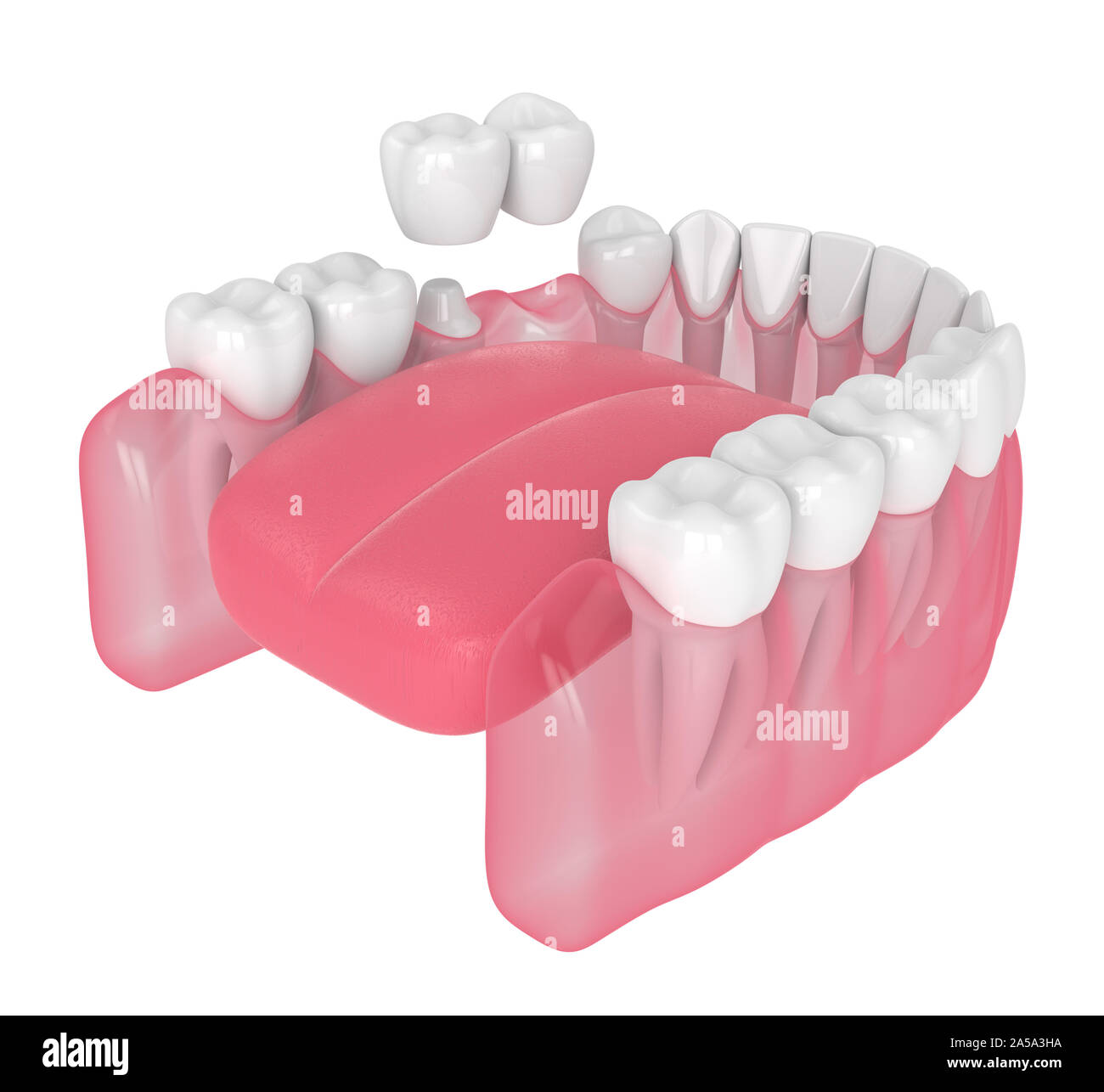 3D render of jaw avec dental pont cantilever sur fond blanc Banque D'Images