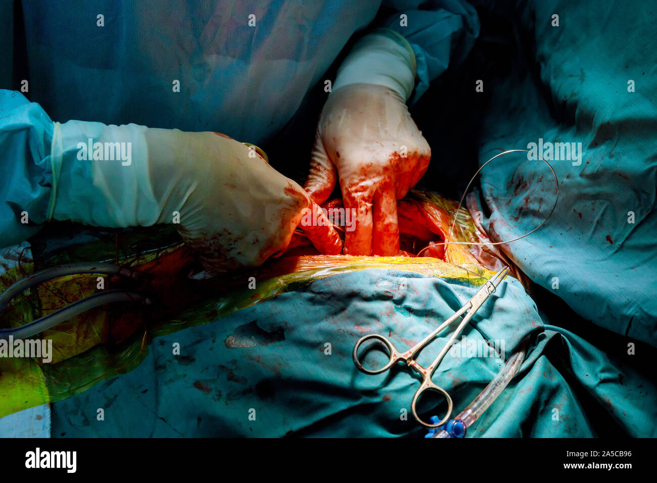 La fermeture de la cavité thoracique avec couple de drains d'une opération sur le coeur Banque D'Images