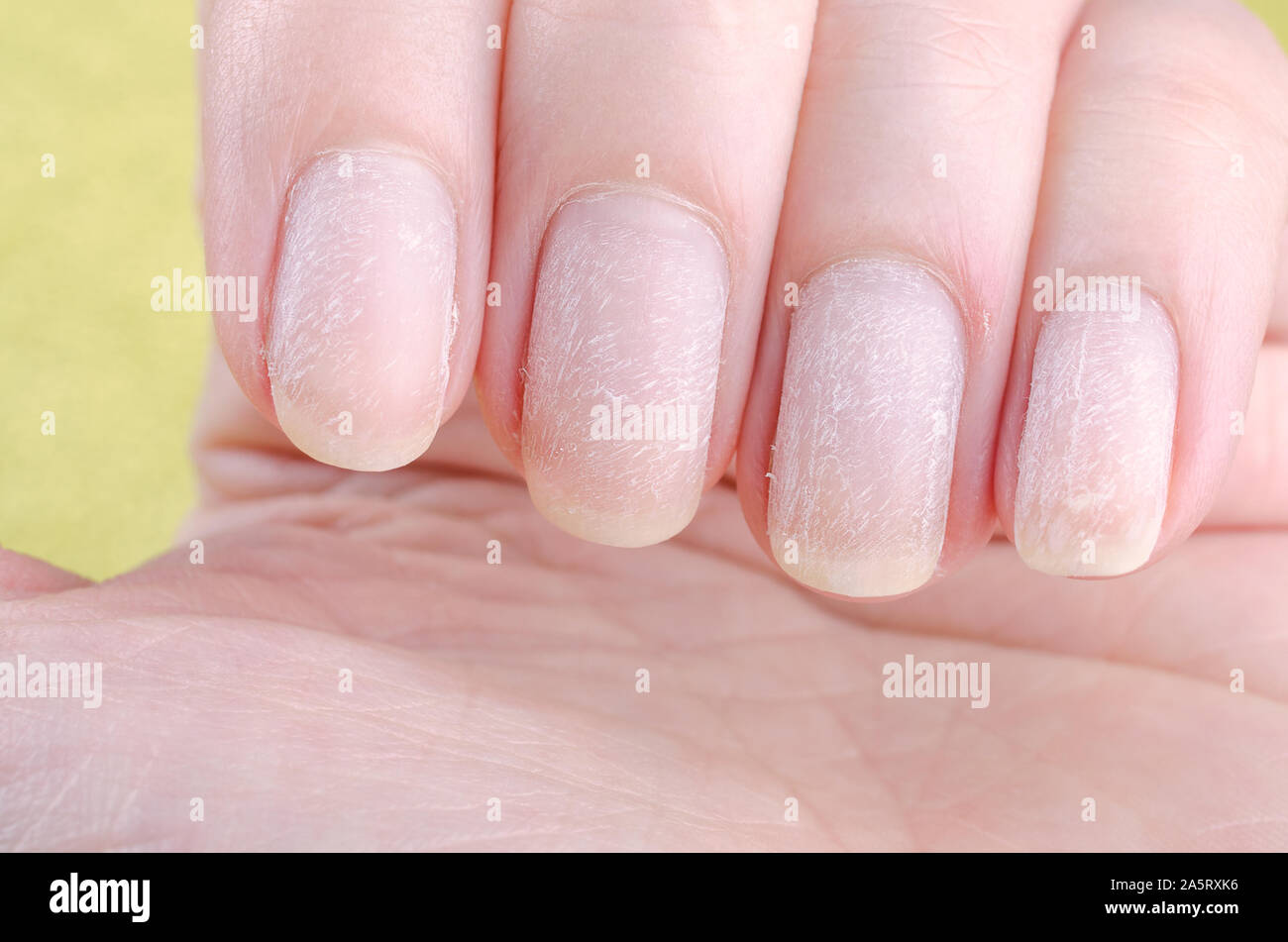 Ongles abîmés Banque de photographies et d’images à haute résolution Alamy