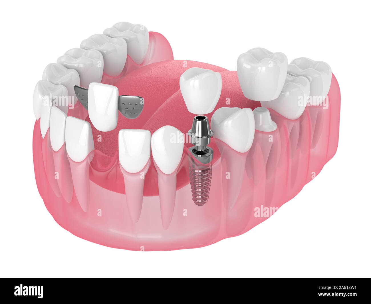 Mâchoire de rendu 3D à l'aide d'implants dentaires et de ponts sur fond blanc Banque D'Images
