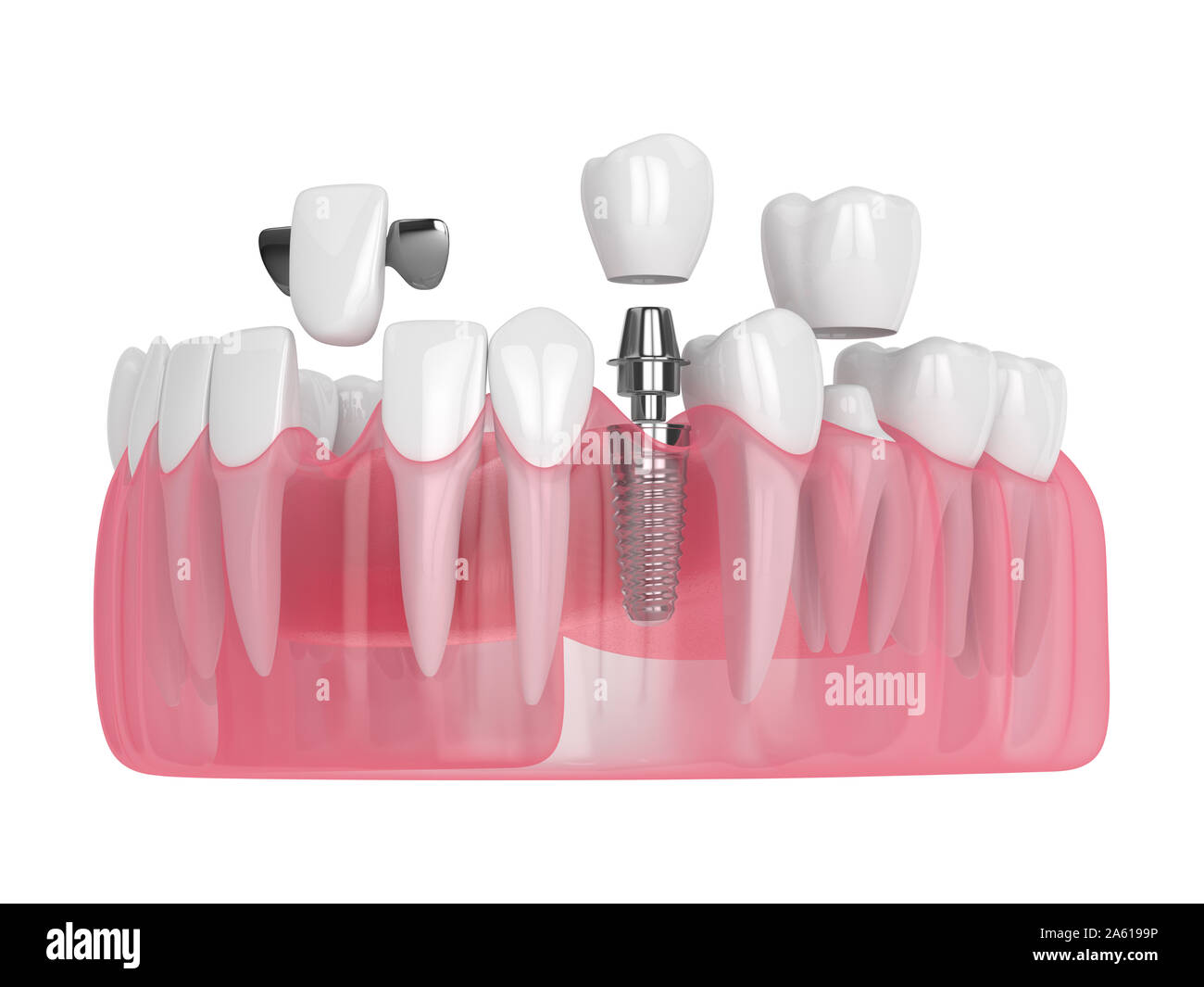 Mâchoire de rendu 3D à l'aide d'implants dentaires et de ponts sur fond blanc Banque D'Images