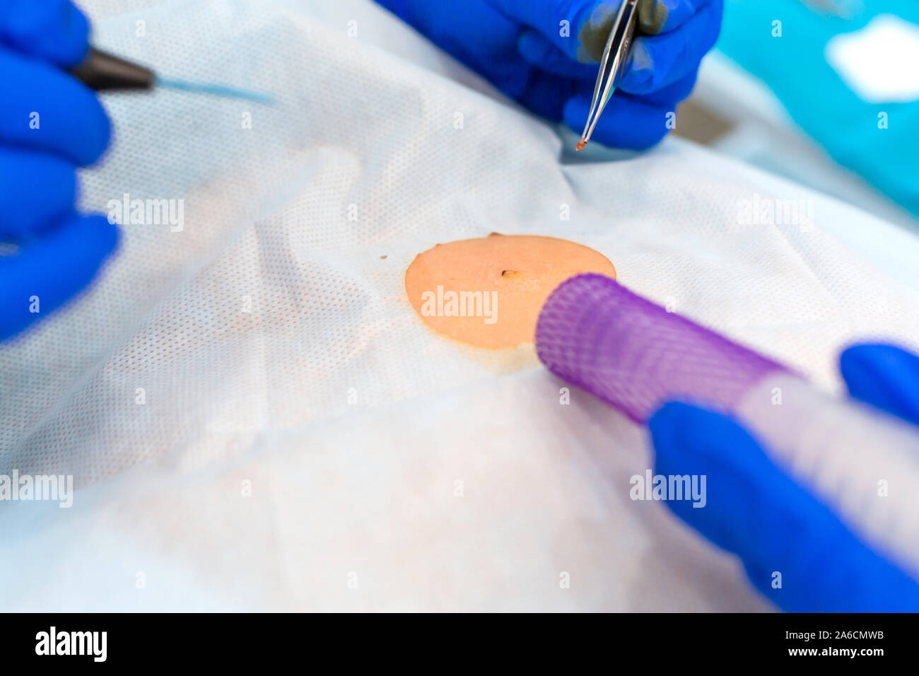 Close-up chirurgien burns une taupe sur le dos du patient. Procédure de chirurgie de déplacement de taupe. Banque D'Images