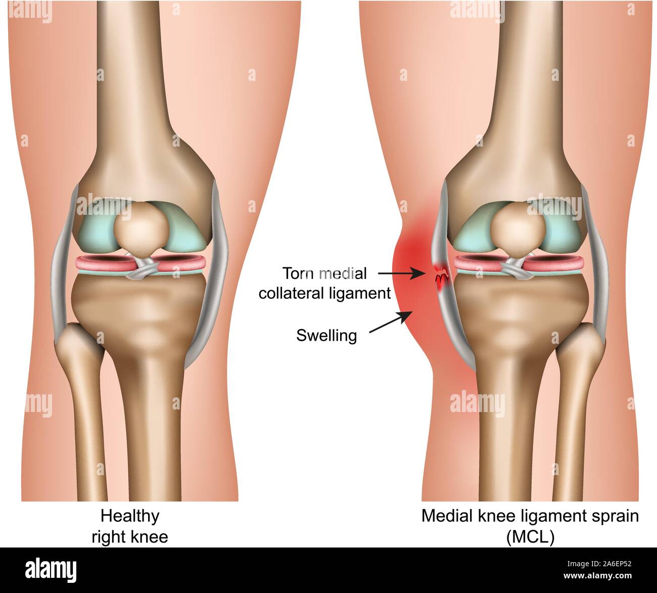 Entorse ligamentaire du genou médial vector illustration médicale isolé sur fond blanc infographie Illustration de Vecteur