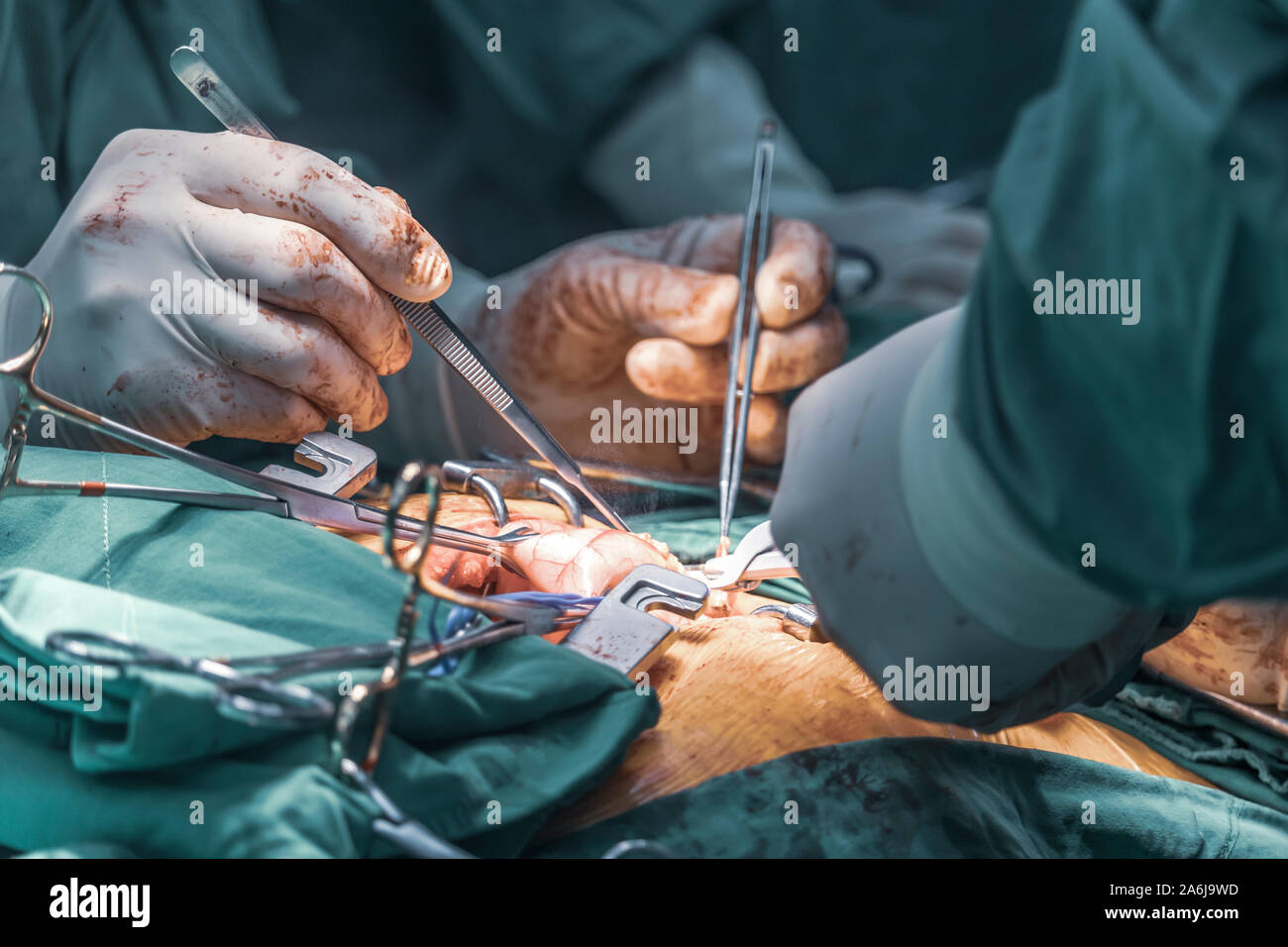 Close up groupe de chirurgiens en chirurgie salle d'opération. L'équipe médicale les chirurgiens de la chirurgie à l'hôpital faire fonctionner. Banque D'Images
