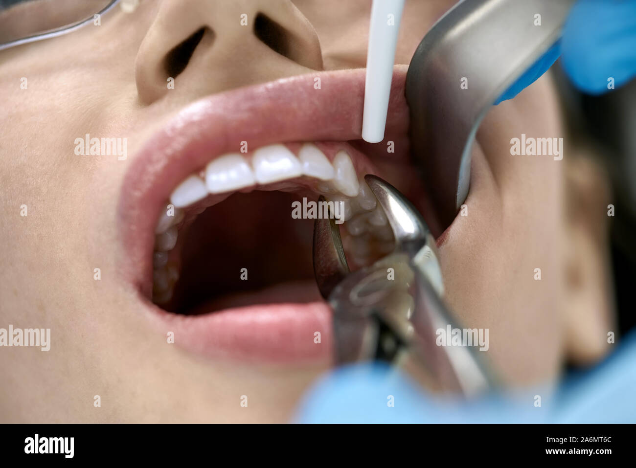 Fille dans des lunettes dans une clinique dentaire. Dentiste en bleu gants en latex est de retirer sa dent avec une aide d'un enrouleur joue et forceps. Closeu Banque D'Images