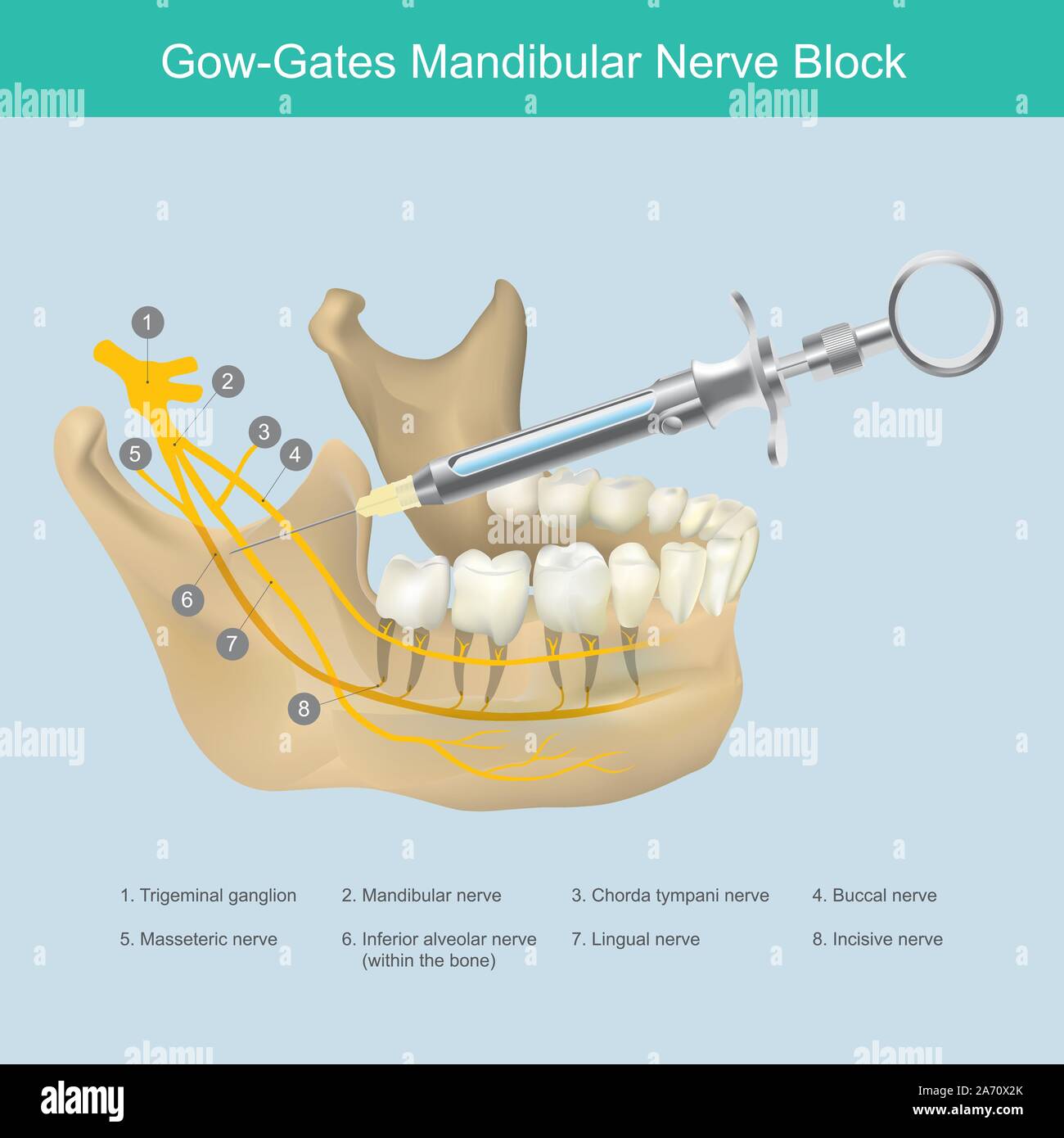 Bloc du nerf mandibulaire. Illustration de la mâchoire inférieure dentiste esthétique zone d'injection, juste pour arrêter la douleur de dents les nerfs. Illustration de Vecteur