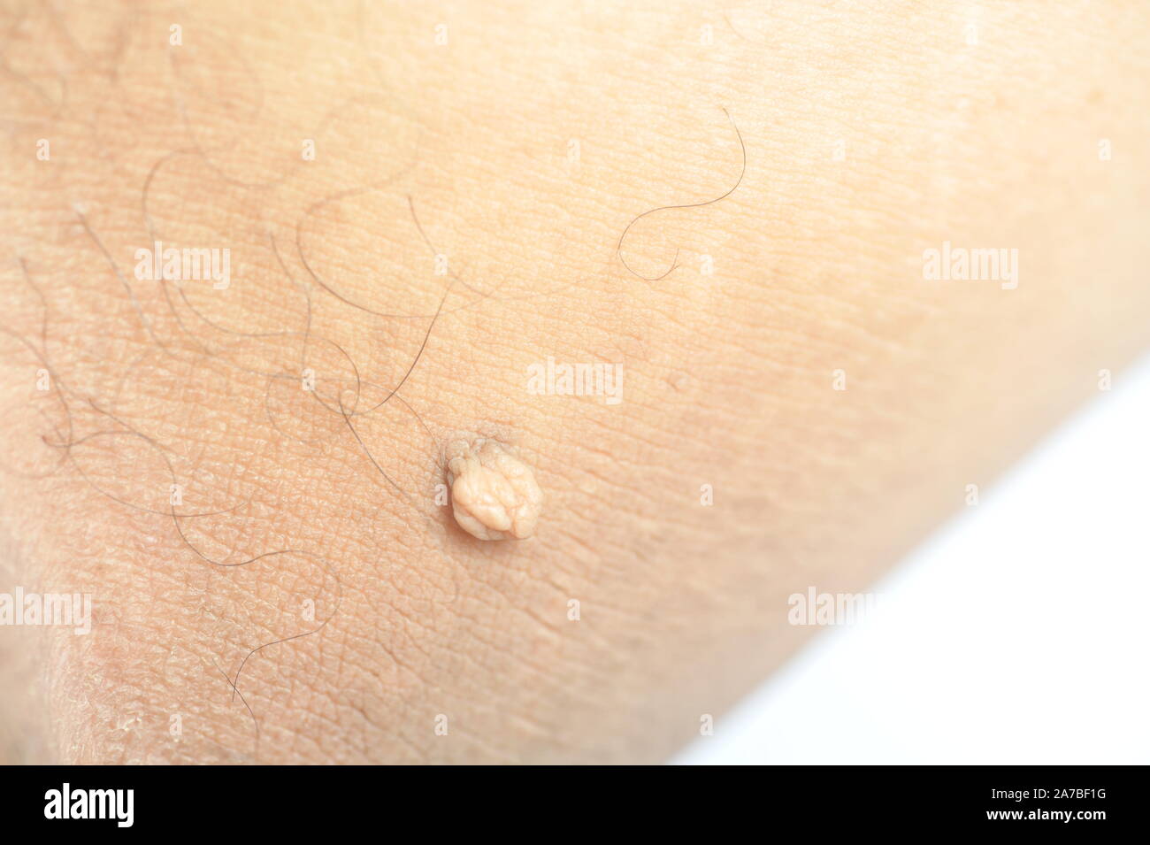 Masse pédiculés ou étiquette de peau ou acrochondon fibrome mou. Images du corps masculin bosse sur un plan macro sur la cuisse Banque D'Images