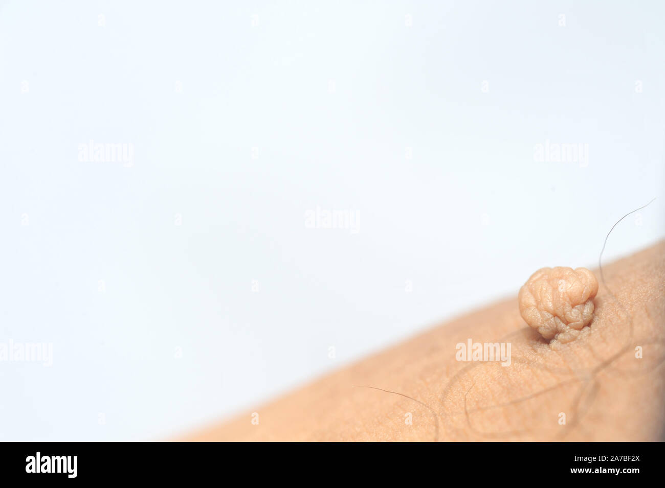 Masse pédiculés ou étiquette de peau ou acrochondon fibrome mou. Images du corps masculin bosse sur un plan macro sur la cuisse Banque D'Images