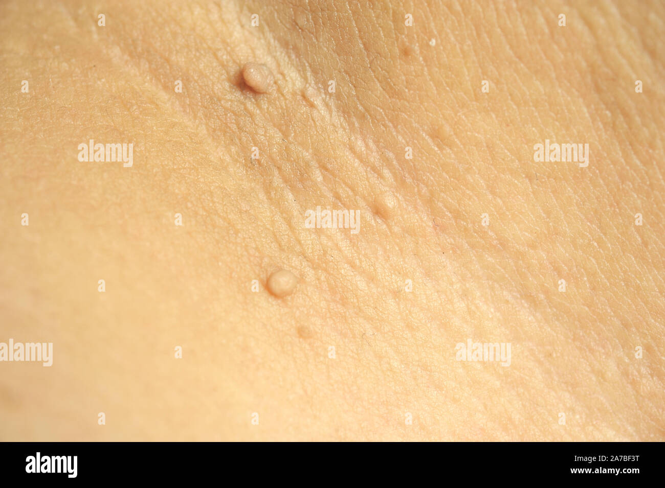 Masse pédiculés ou étiquette de peau ou acrochondon fibrome mou. Images du corps masculin bosse sur un plan macro sur la cuisse Banque D'Images