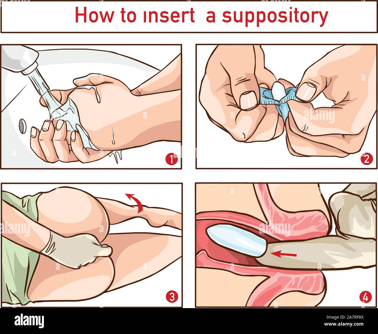 Dessin pour montrer l'emplacement et la technique de l'insertion d'un suppositoire pour la distribution de médicaments par le rectum Illustration de Vecteur