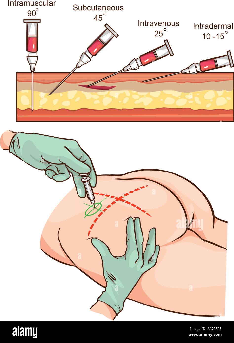 L'injection intramusculaire vector illustration et la comparaison des angles de l'injection intramusculaire. Illustration de Vecteur