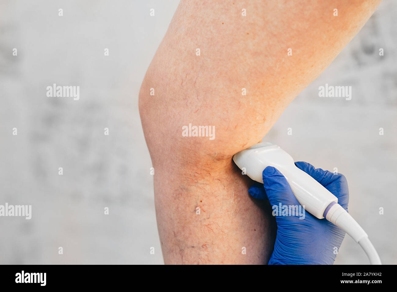 L'examen échographique recadrée nervures de la jambe, thromboses veineuses, varices Banque D'Images