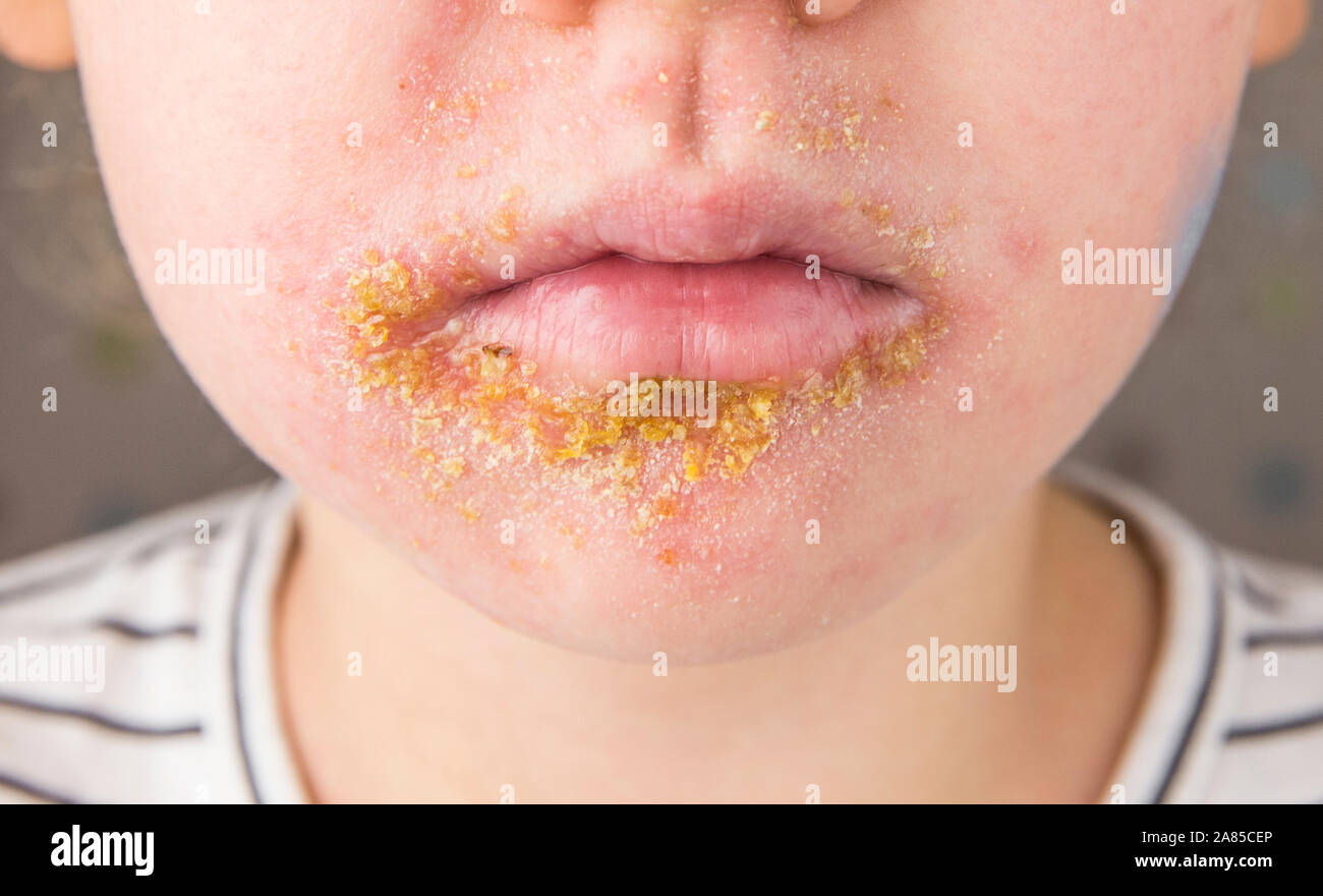 Impetigo Staphylococcus Banque D Image Et Photos Alamy Impetigo Staphylococcus Banque D Image Et Photos Alamy
