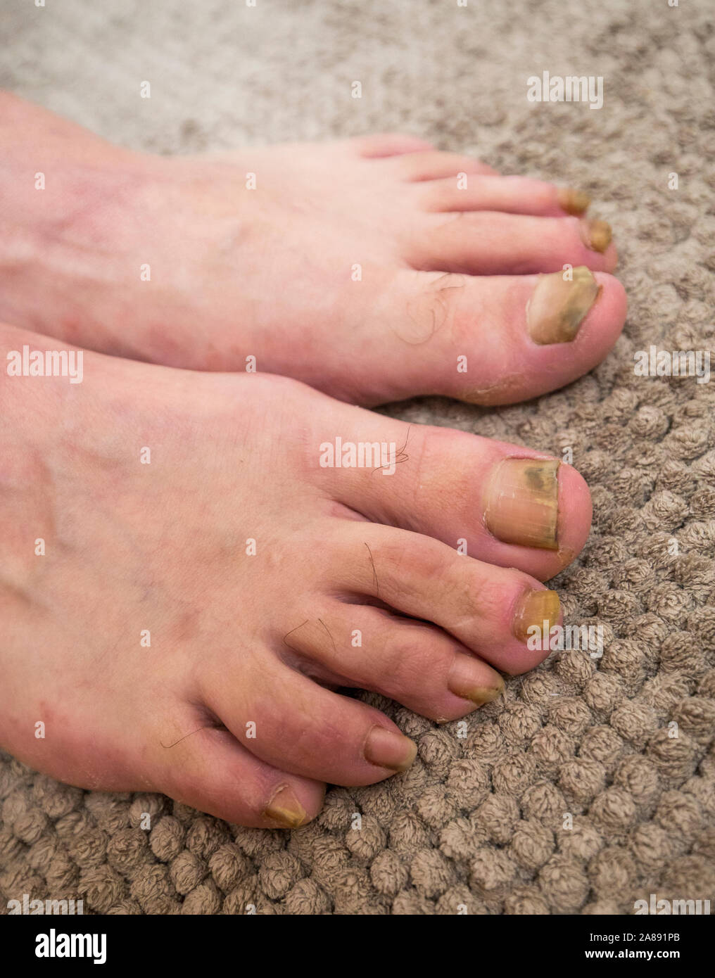 L'onychomycose infection fongiques des ongles avec deux pieds. Banque D'Images