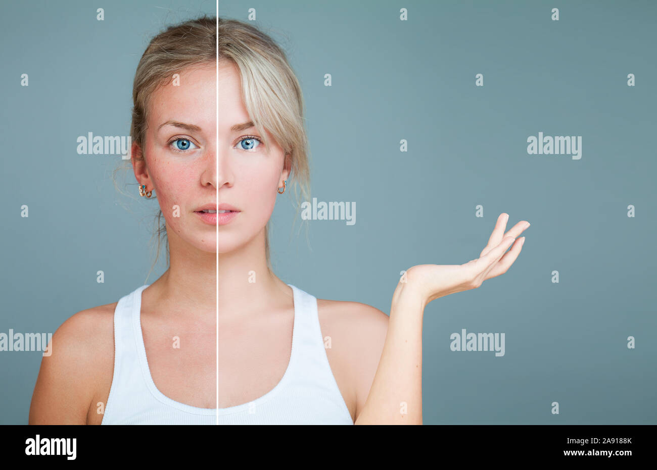 Jeune femme à main levée. Malsaine et la santé de la peau après le traitement. Traitement du visage, de la médecine et Cosmétologie Concept. La peau parfaite et la peau Pr Banque D'Images