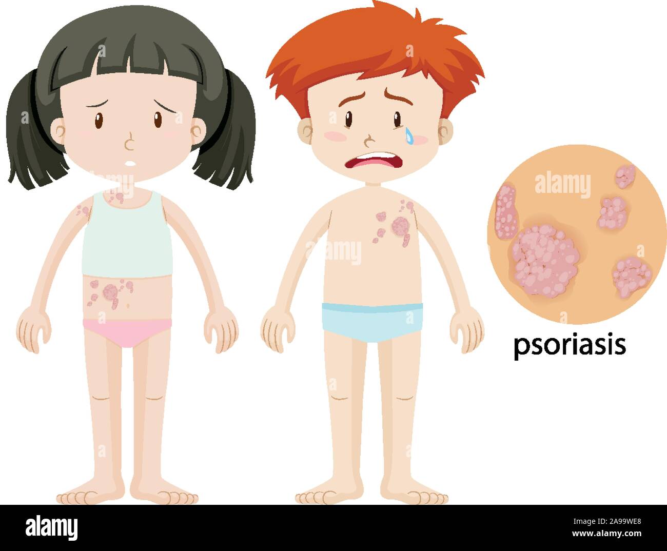 Garçon et fille avec le psoriasis illustration Illustration de Vecteur