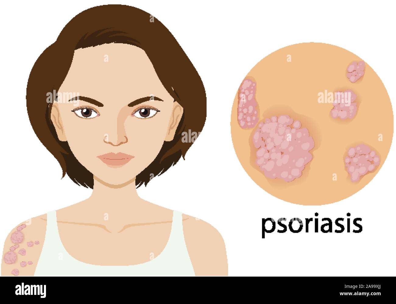 Femme avec psoriasis sur l'illustration de l'affiche Illustration de Vecteur