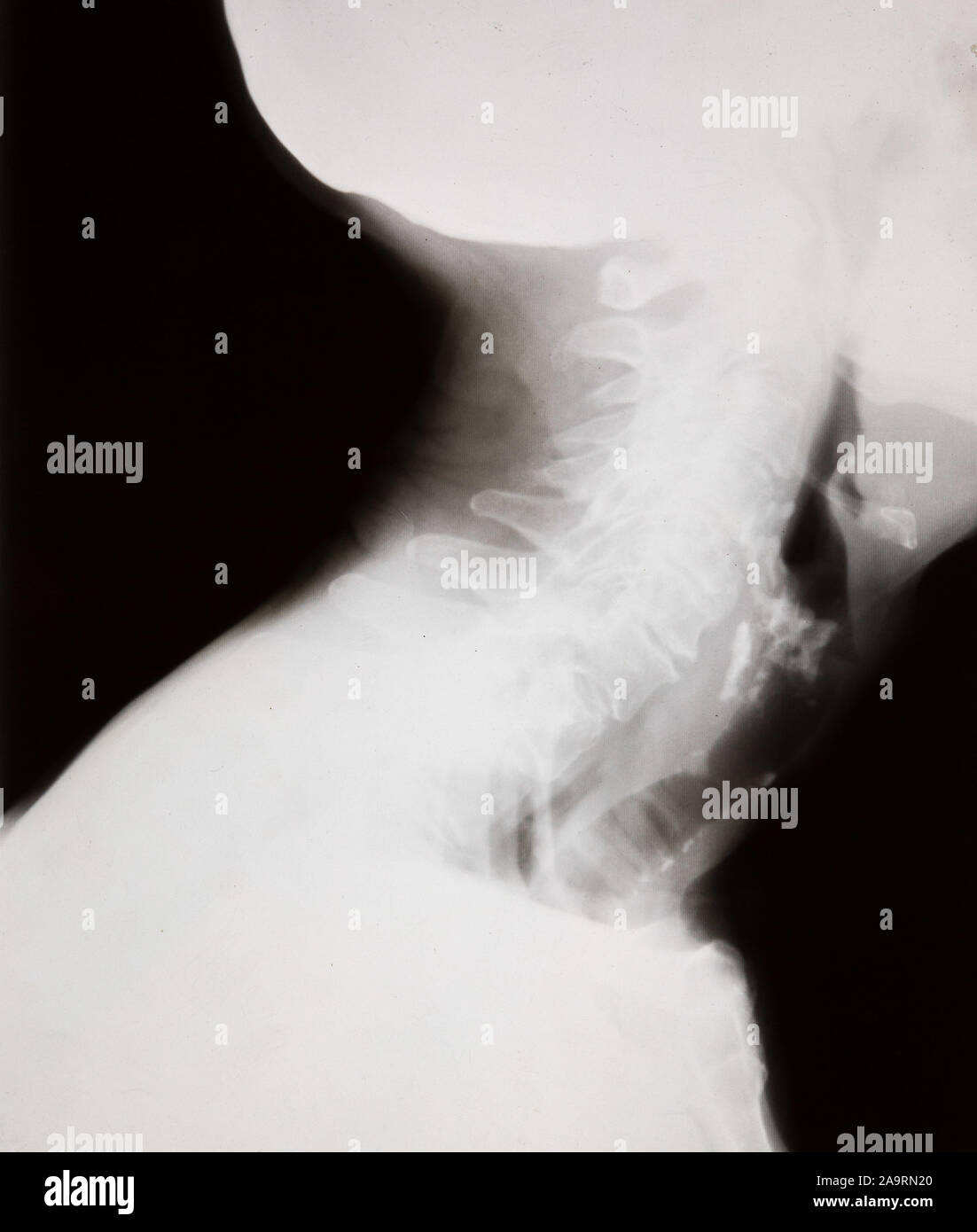 Vue sur le côté d'une radiographie d'une tête humaine, le cou et les épaules Banque D'Images