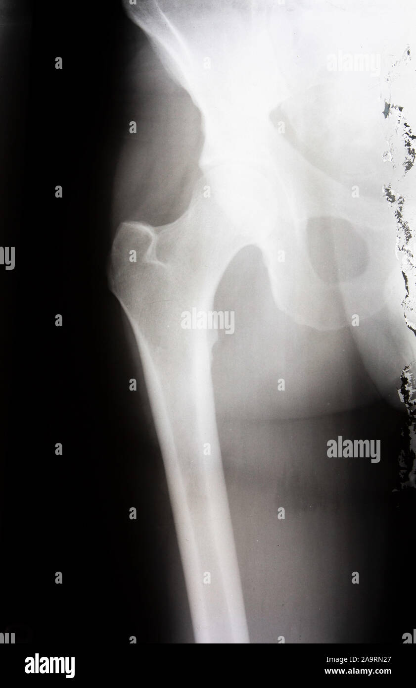 X-ray de la hanche et la jambe. Banque D'Images