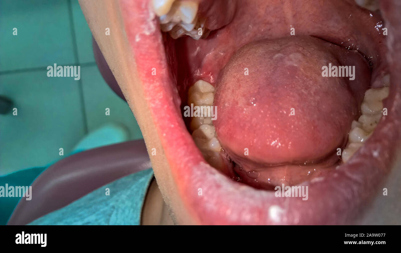 Bouche ouverte avec dents et langue maternelle. Problèmes dentaires. des cavités dans les dents. Banque D'Images