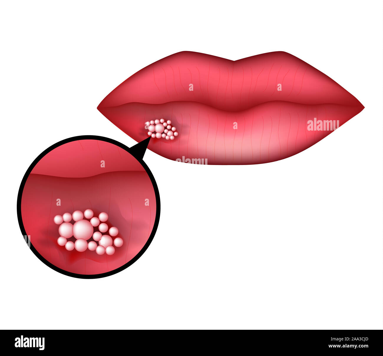 L'herpès sur la lèvre. L'infographie. illustration sur fond isolé. Banque D'Images